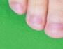 Подногтевая меланома: причины появления, диагностика и методы лечения Бывает ли меланома на двух ногтях