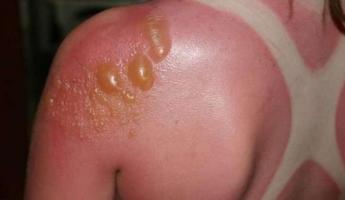Treating burns with blisters at home